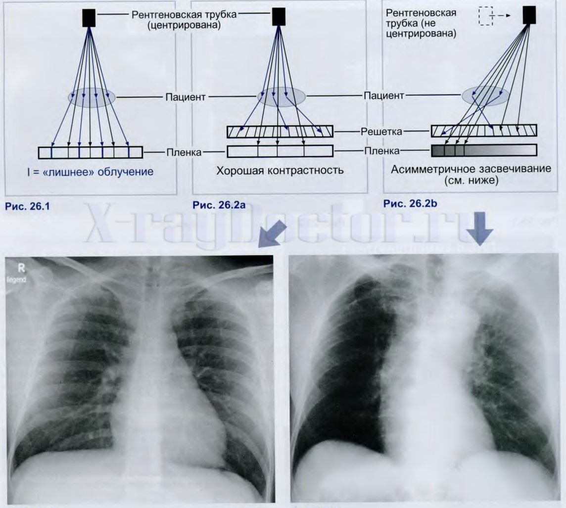 Схема влияния отсеивающей решетки рентген аппарата на качество снимков
